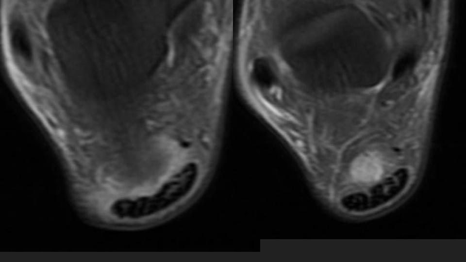Figure 1 for case retrocalcaneal bursa ( RID3217 )